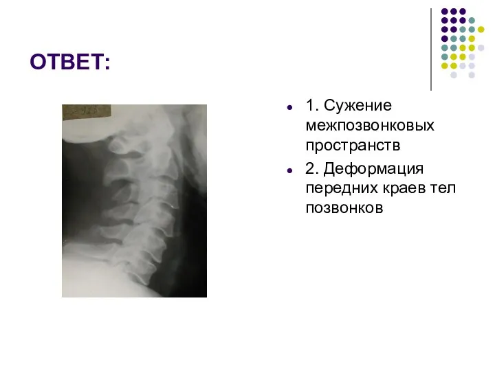 ОТВЕТ: 1. Сужение межпозвонковых пространств 2. Деформация передних краев тел позвонков