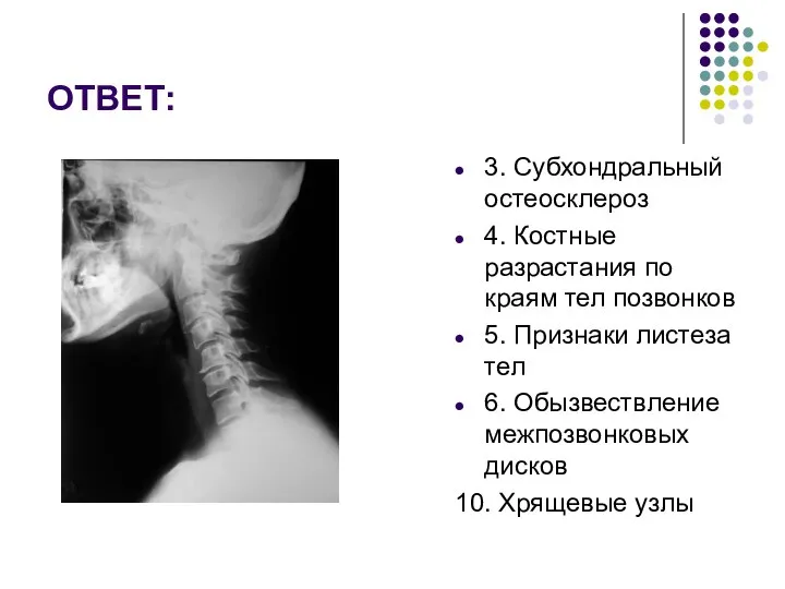 ОТВЕТ: 3. Субхондральный остеосклероз 4. Костные разрастания по краям тел позвонков