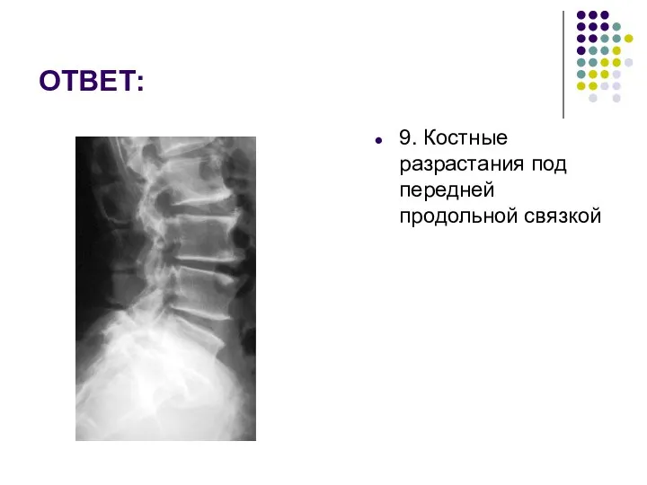 ОТВЕТ: 9. Костные разрастания под передней продольной связкой