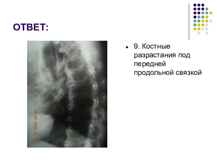 ОТВЕТ: 9. Костные разрастания под передней продольной связкой