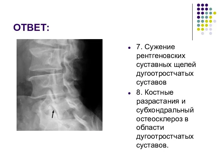 ОТВЕТ: 7. Сужение рентгеновских суставных щелей дугоотростчатых суставов 8. Костные разрастания