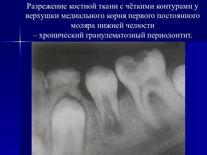 Разрежение костной ткани с чёткими контурами у верхушки медиального корня первого