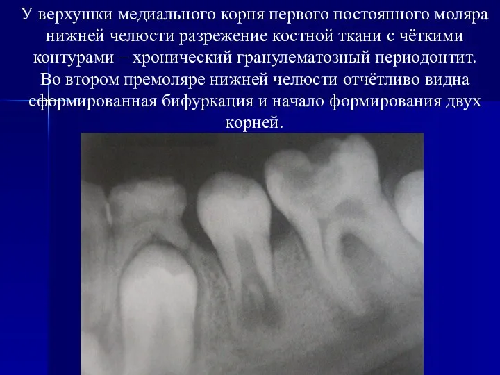 У верхушки медиального корня первого постоянного моляра нижней челюсти разрежение костной