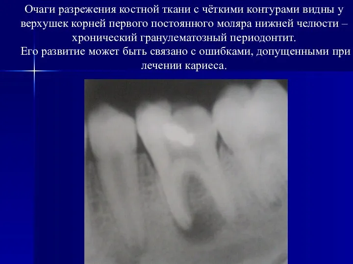Очаги разрежения костной ткани с чёткими контурами видны у верхушек корней