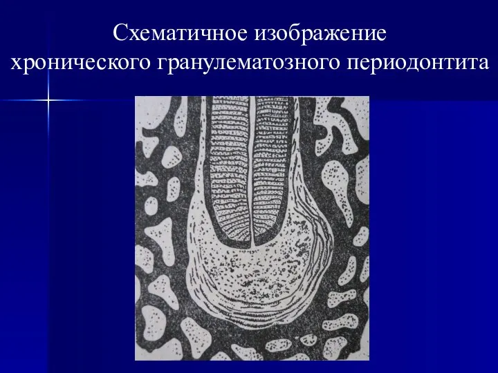 Схематичное изображение хронического гранулематозного периодонтита