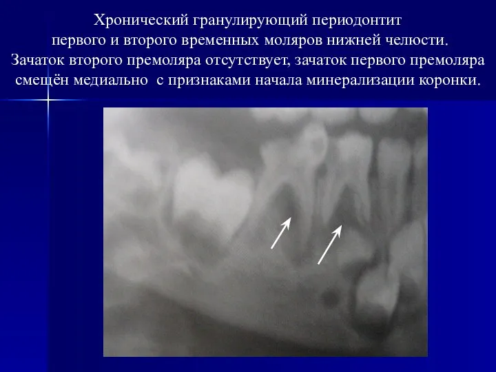 Хронический гранулирующий периодонтит первого и второго временных моляров нижней челюсти. Зачаток