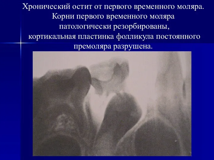 Хронический остит от первого временного моляра. Корни первого временного моляра патологически