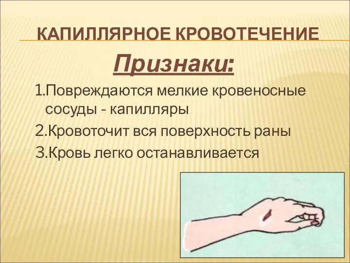 Признаки: 1.Повреждаются мелкие кровеносные сосуды - капилляры 2.Кровоточит вся поверхность раны 3.Кровь легко останавливается КАПИЛЛЯРНОЕ КРОВОТЕЧЕНИЕ