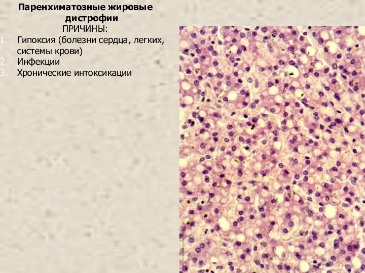 Паренхиматозные жировые дистрофии ПРИЧИНЫ: Гипоксия (болезни сердца, легких, системы крови) Инфекции Хронические интоксикации