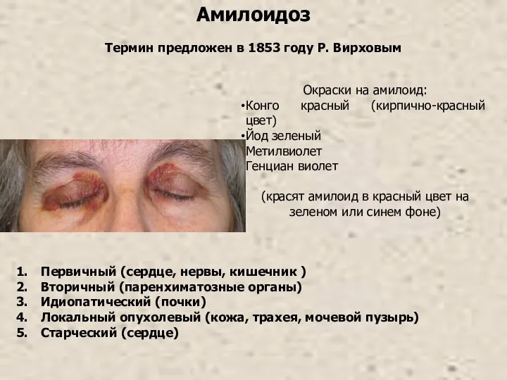 Амилоидоз Первичный (сердце, нервы, кишечник ) Вторичный (паренхиматозные органы) Идиопатический (почки)