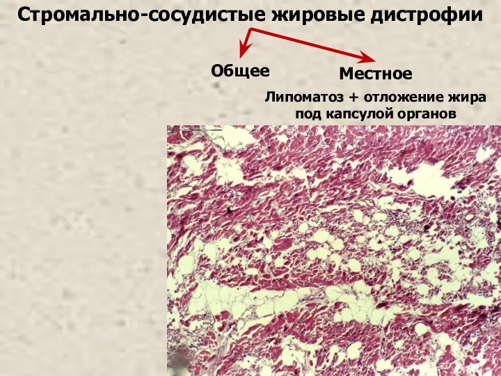 Стромально-сосудистые жировые дистрофии Местное Липоматоз + отложение жира под капсулой органов Общее