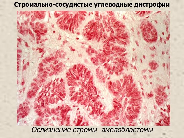 Ослизнение стромы амелобластомы Стромально-сосудистые углеводные дистрофии