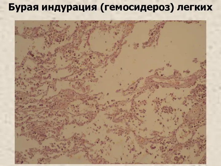 Бурая индурация (гемосидероз) легких