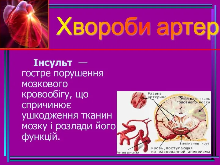 Хвороби артерій Інсульт — гостре порушення мозкового кровообігу, що спричинює ушкодження