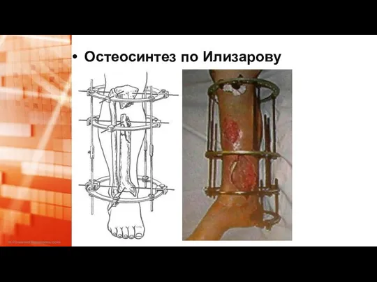 Остеосинтез по Илизарову