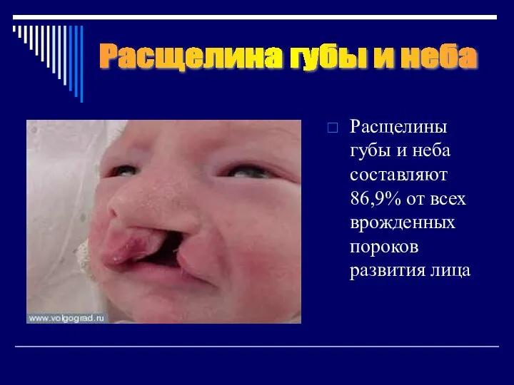 Расщелины губы и неба составляют 86,9% от всех врожденных пороков развития лица Расщелина губы и неба