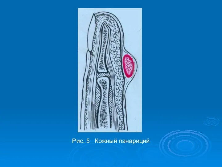 Рис. 5 Кожный панариций