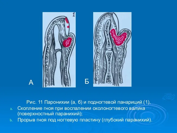 Рис. 11 Паронихии (а, б) и подногтевой панариций (1). Скопление гноя