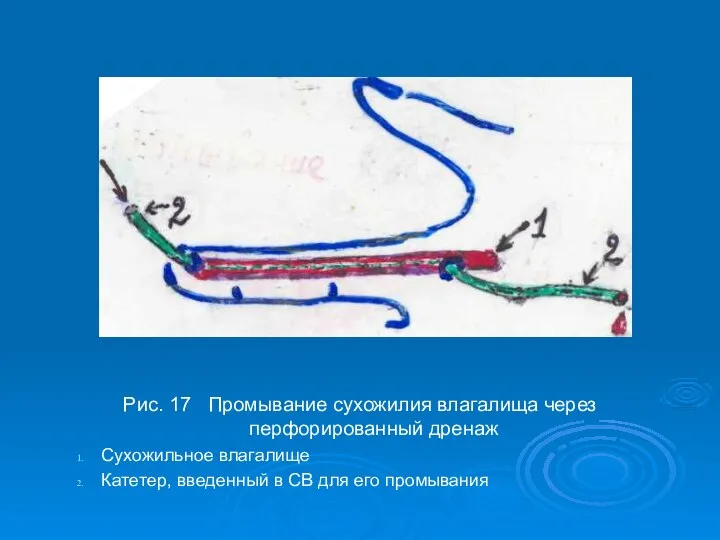 Рис. 17 Промывание сухожилия влагалища через перфорированный дренаж Сухожильное влагалище Катетер,