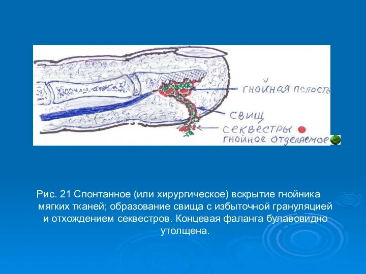 Рис. 21 Спонтанное (или хирургическое) вскрытие гнойника мягких тканей; образование свища