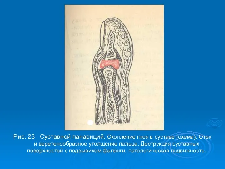 Рис. 23 Суставной панариций. Скопление гноя в суставе (схема). Отек и