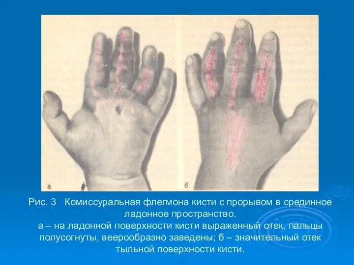 Рис. 3 Комиссуральная флегмона кисти с прорывом в срединное ладонное пространство.