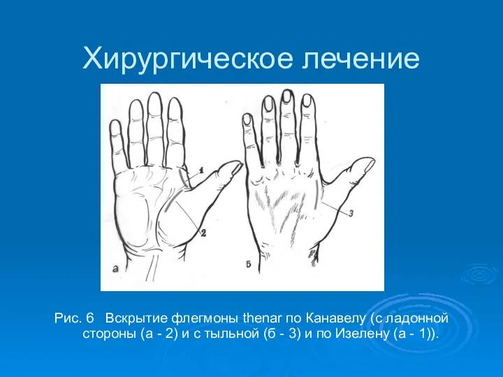 Хирургическое лечение Рис. 6 Вскрытие флегмоны thenar по Канавелу (с ладонной