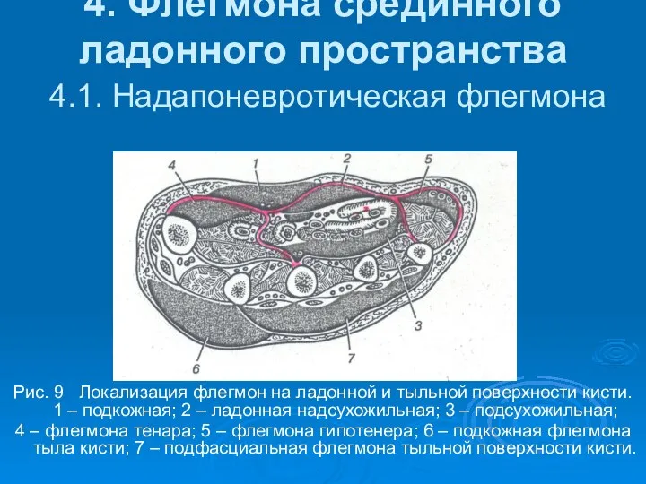 4. Флегмона срединного ладонного пространства 4.1. Надапоневротическая флегмона Рис. 9 Локализация