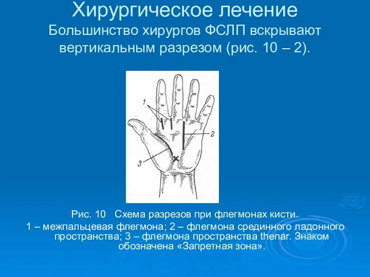 Хирургическое лечение Большинство хирургов ФСЛП вскрывают вертикальным разрезом (рис. 10 –