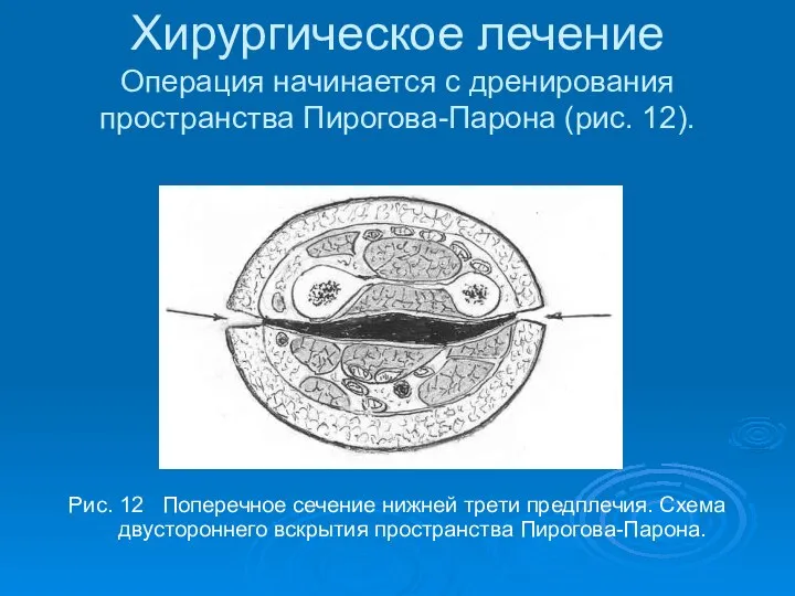 Хирургическое лечение Операция начинается с дренирования пространства Пирогова-Парона (рис. 12). Рис.