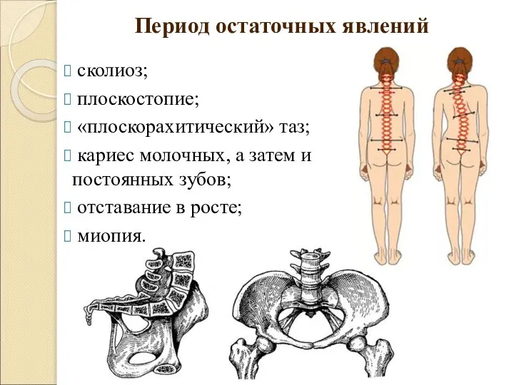 Период остаточных явлений сколиоз; плоскостопие; «плоскорахитический» таз; кариес молочных, а затем