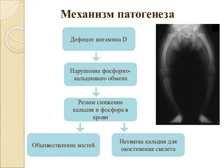 Механизм патогенеза Дефицит витамина D Нарушение фосфорно-кальциевого обмена Резкое снижение кальция