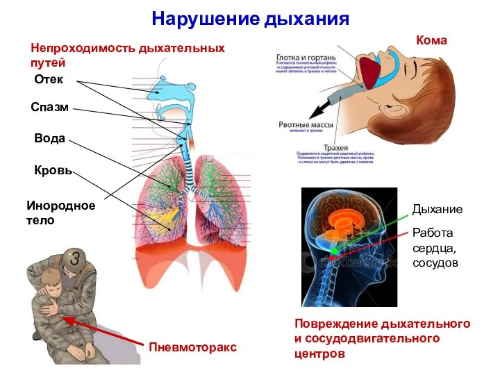 Нарушение дыхания Кома Пневмоторакс Работа сердца, сосудов Непроходимость дыхательных путей Спазм