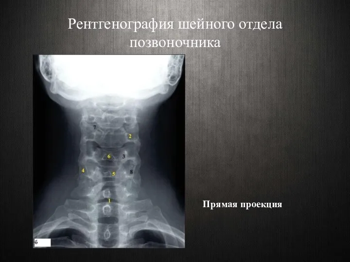 Рентгенография шейного отдела позвоночника Прямая проекция