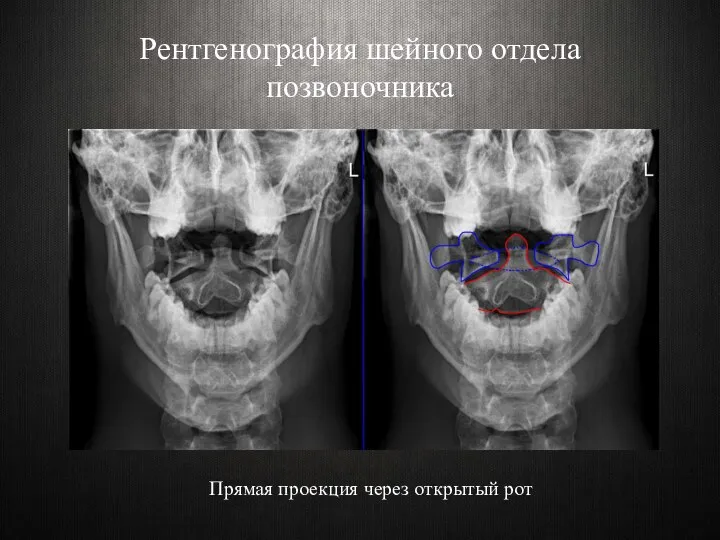 Рентгенография шейного отдела позвоночника Прямая проекция через открытый рот