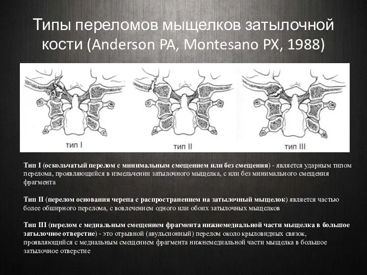 Типы переломов мыщелков затылочной кости (Anderson PA, Montesano PX, 1988) Тип