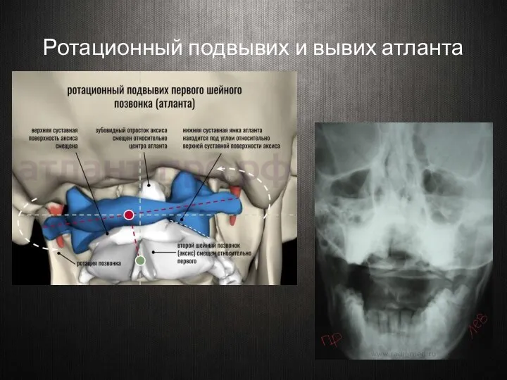 Ротационный подвывих и вывих атланта