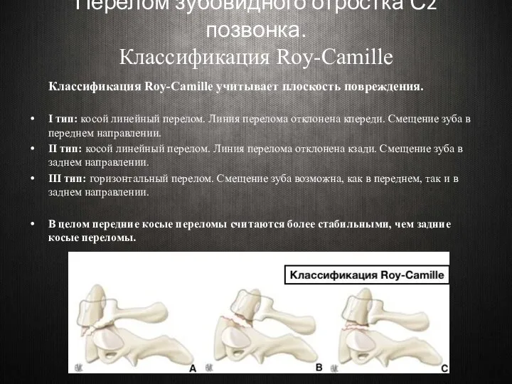 Перелом зубовидного отростка С2 позвонка. Классификация Roy-Camille Классификация Roy-Camille учитывает плоскость