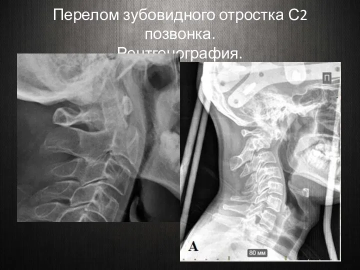 Перелом зубовидного отростка С2 позвонка. Рентгенография.