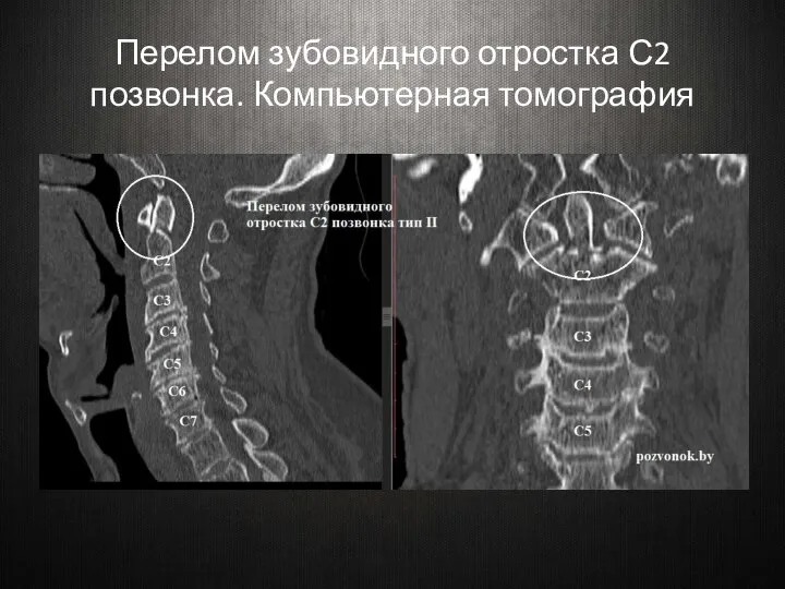 Перелом зубовидного отростка С2 позвонка. Компьютерная томография