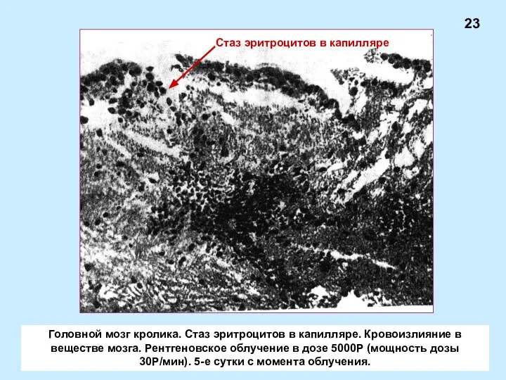 Головной мозг кролика. Стаз эритроцитов в капилляре. Кровоизлияние в веществе мозга.