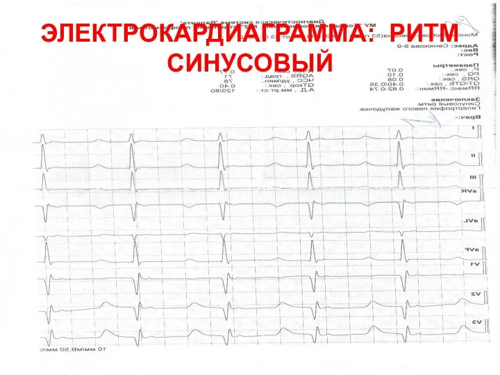 ЭЛЕКТРОКАРДИАГРАММА: РИТМ СИНУСОВЫЙ