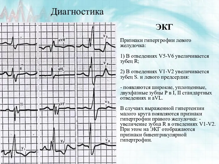 Диагностика ЭКГ Признаки гипертрофии левого желудочка: 1) В отведениях V5-V6 увеличивается