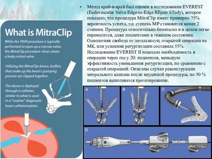 Метод край-в-край был оценен в исследовании EVEREST (Endovascular Valva Edge-to-Edge REpair