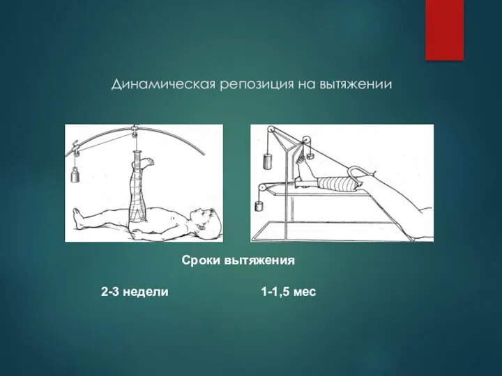 Динамическая репозиция на вытяжении Сроки вытяжения 2-3 недели 1-1,5 мес