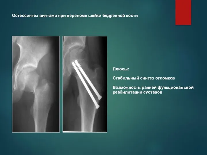 Остеосинтез винтами при переломе шейки бедренной кости Плюсы: Стабильный синтез отломков Возможность ранней функциональной реабилитации суставов