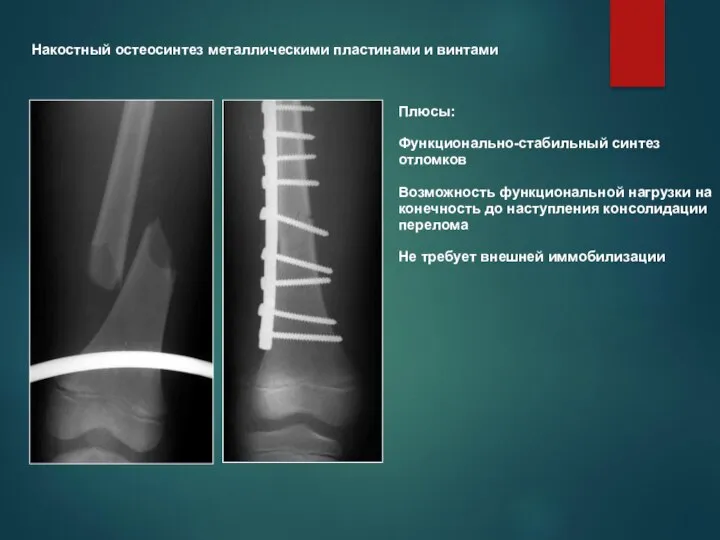 Накостный остеосинтез металлическими пластинами и винтами Плюсы: Функционально-стабильный синтез отломков Возможность