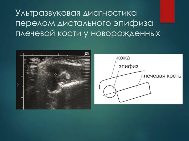 Ультразвуковая диагностика перелом дистального эпифиза плечевой кости у новорожденных