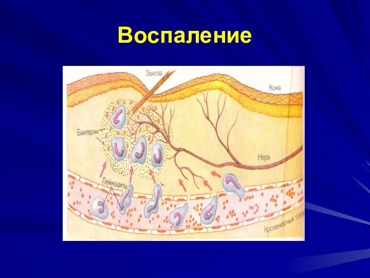 Воспаление