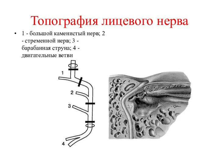 Топография лицевого нерва 1 - большой каменистый нерв; 2 - стременной